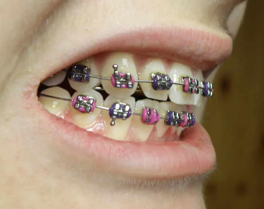 What Are The Benefits Of Dental Braces?